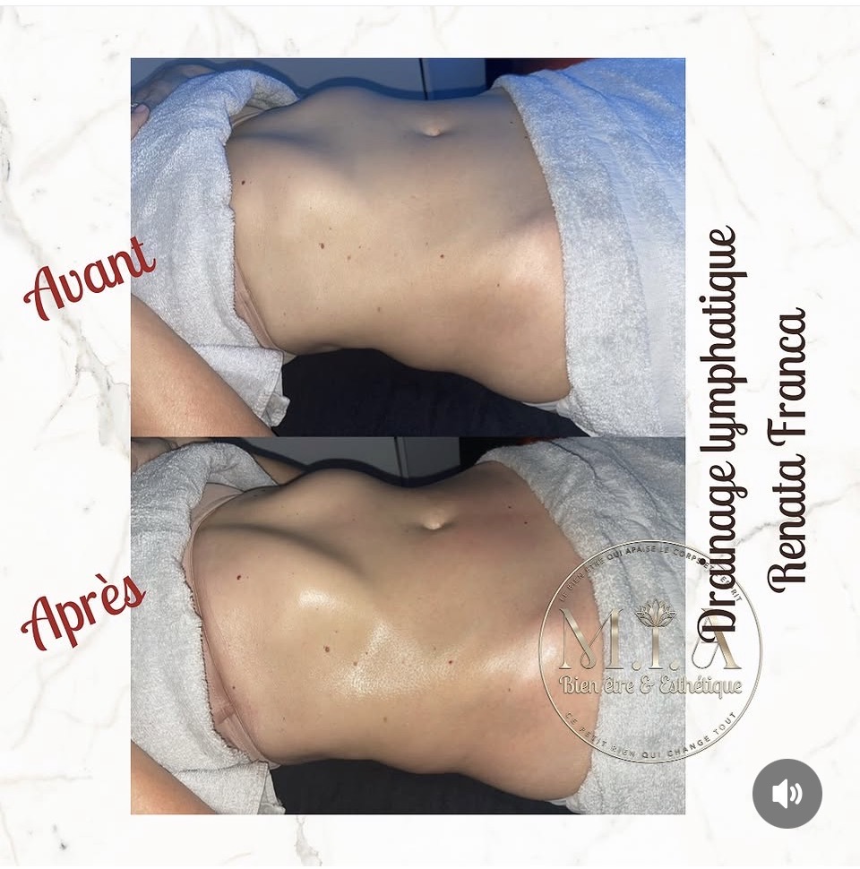 Drainage lymphatique Renata França — résultat avant et après 5