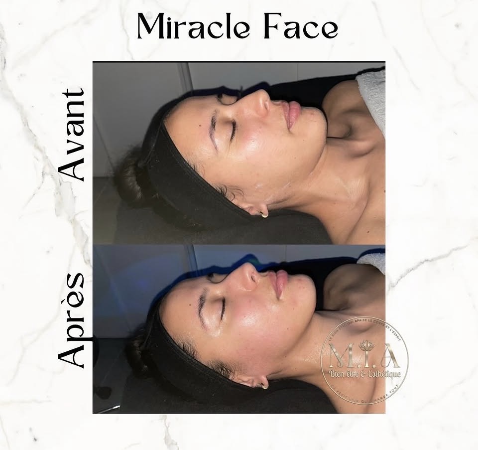 Miracle Face Renata França — résultat avant et après 10