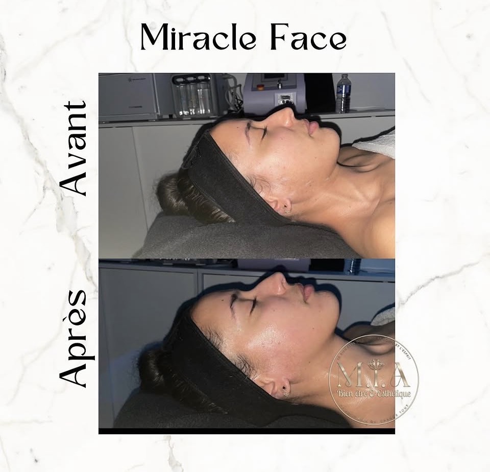 Miracle Face Renata França — résultat avant et après 11