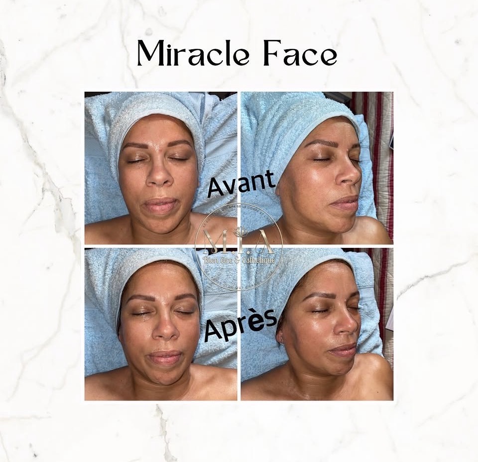 Miracle Face Renata França — résultat avant et après 12