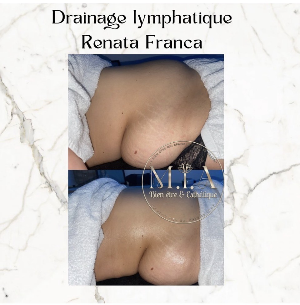 Drainage lymphatique Renata França — résultat avant et après 13