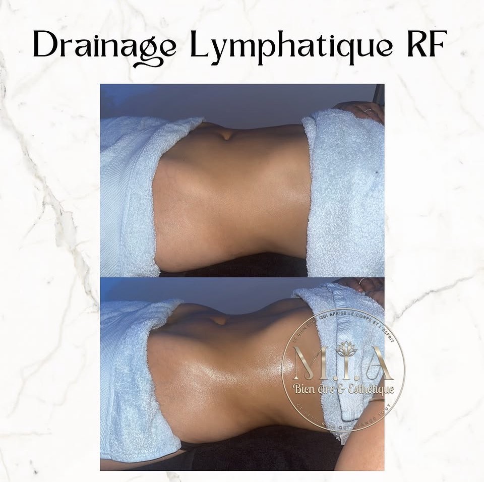 Drainage lymphatique Renata França — résultat avant et après 14