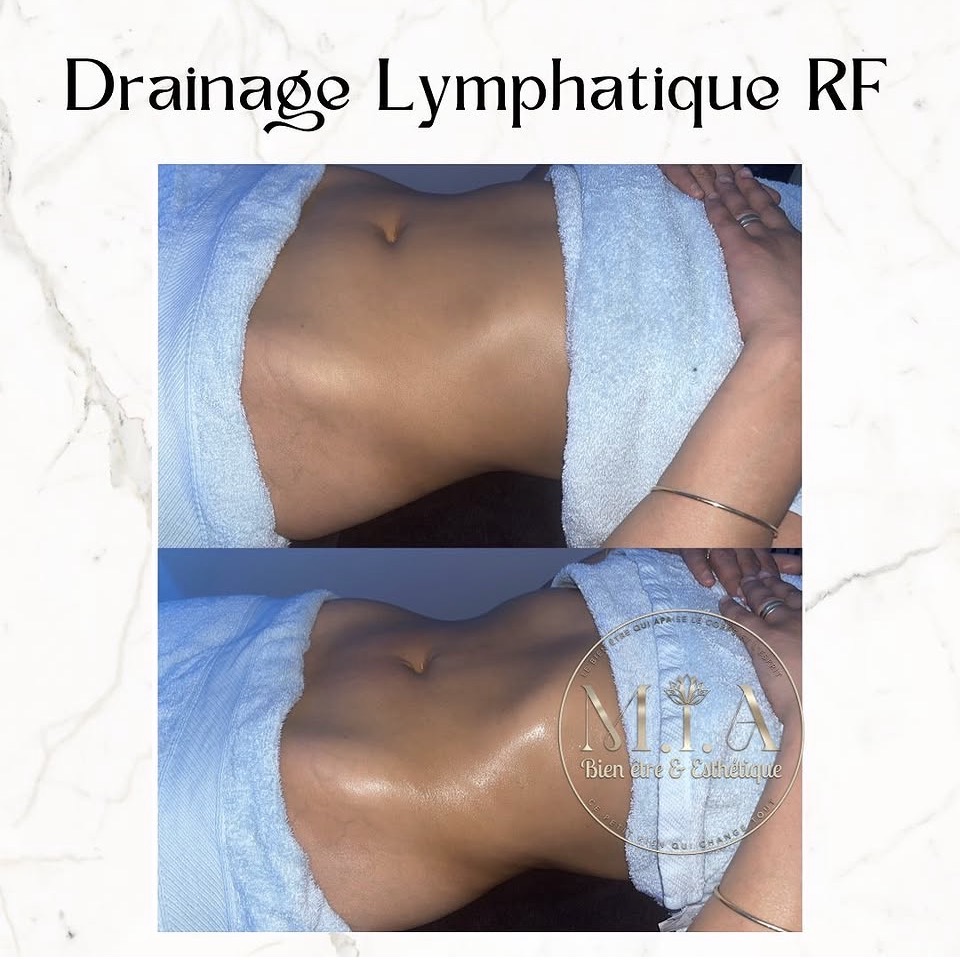 Drainage lymphatique Renata França — résultat avant et après 15
