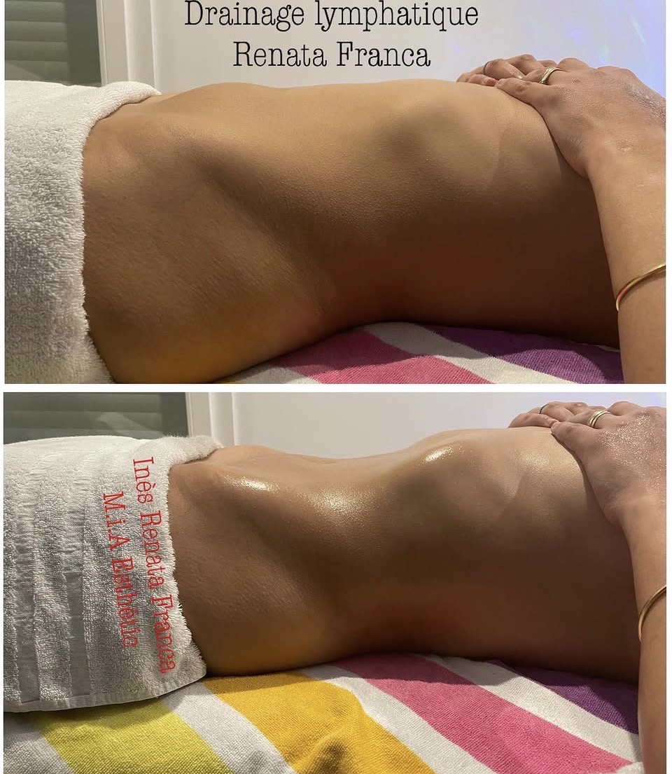 Drainage lymphatique Renata França — résultat avant et après 16