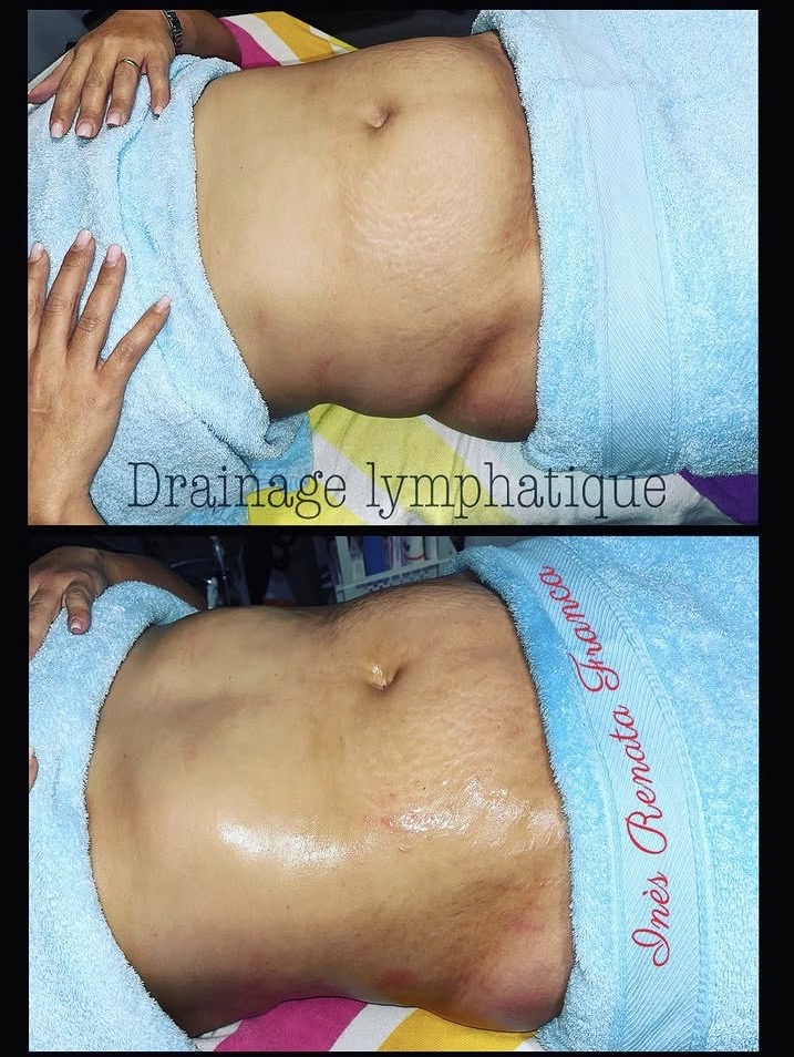 Drainage lymphatique Renata França — résultat avant et après 18